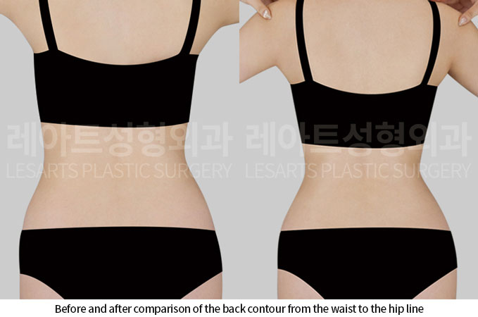 abdominal-liposuction-02-03-260703