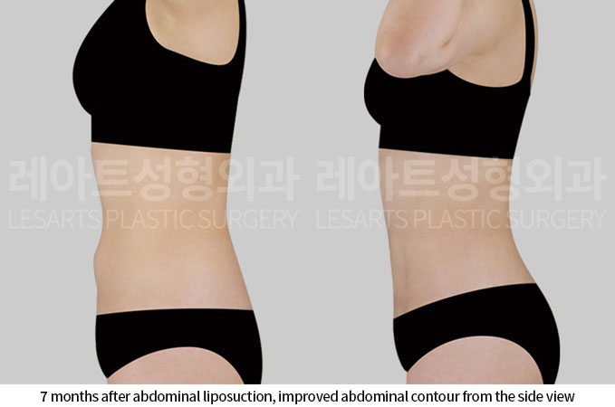 abdominal-liposuction-02-04-260703