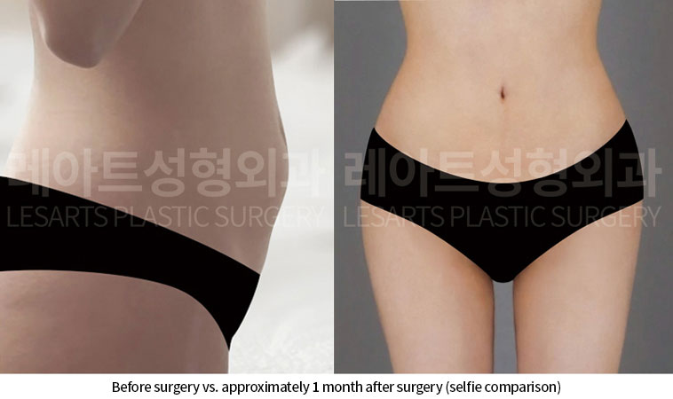 abdominal-liposuction-02-05-260703