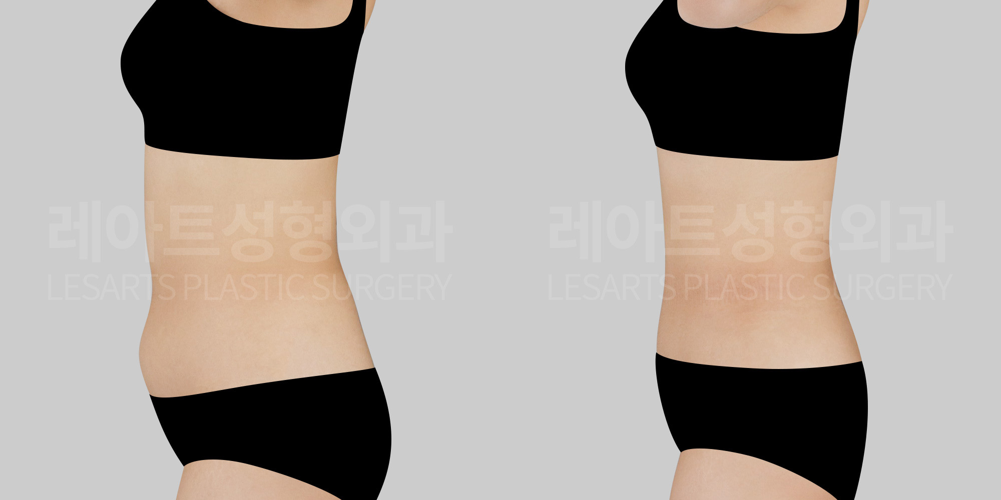 Abdominal Liposuction-Why Is My Lower Belly Still There After Losing 5 kg? Understanding Persistent Lower Abdominal Fullness