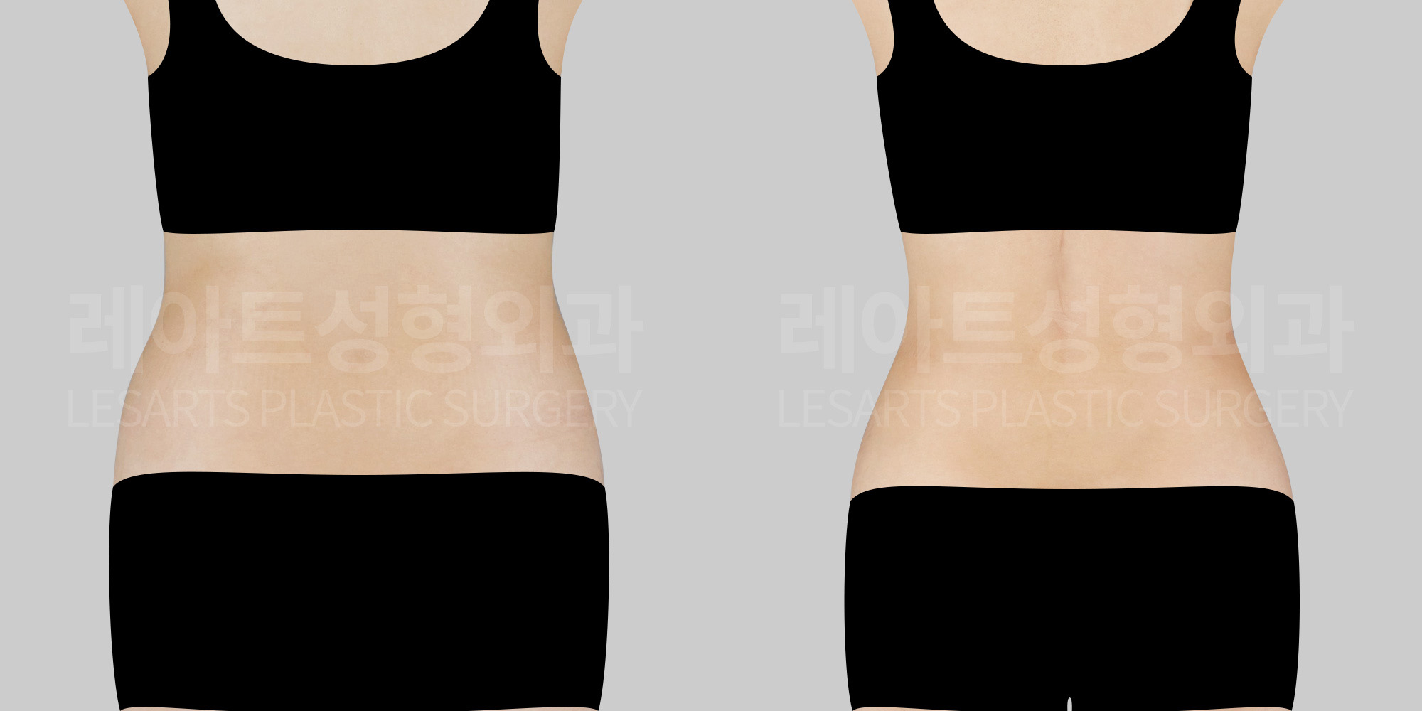 Abdominal Liposuction: Removing Stubborn Postpartum Lower Belly and Waist Fat with Liposuction