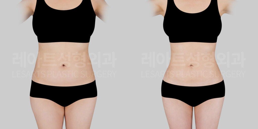 abdominal-liposuction-hip-fat-grafting-28466-before-after-lesarts