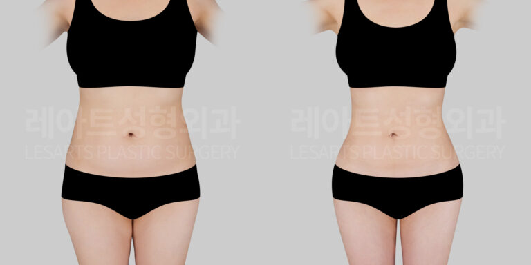 abdominal-liposuction-hip-fat-grafting-28466-before-after-lesarts