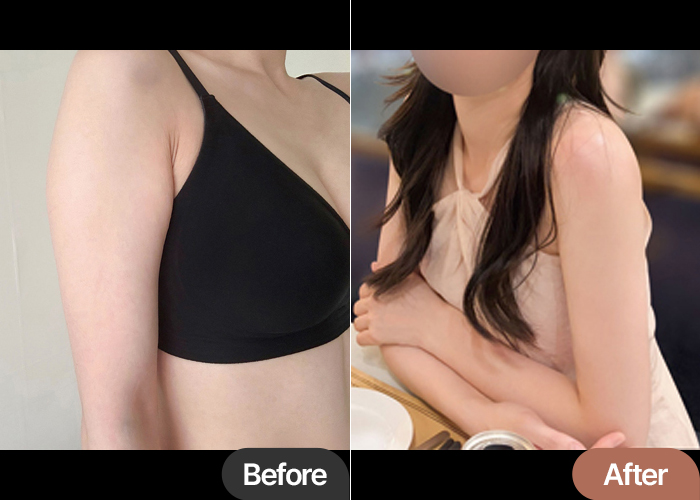 abdominal-liposuction-thumbnail-arm-liposuction-jjangjjangohyes