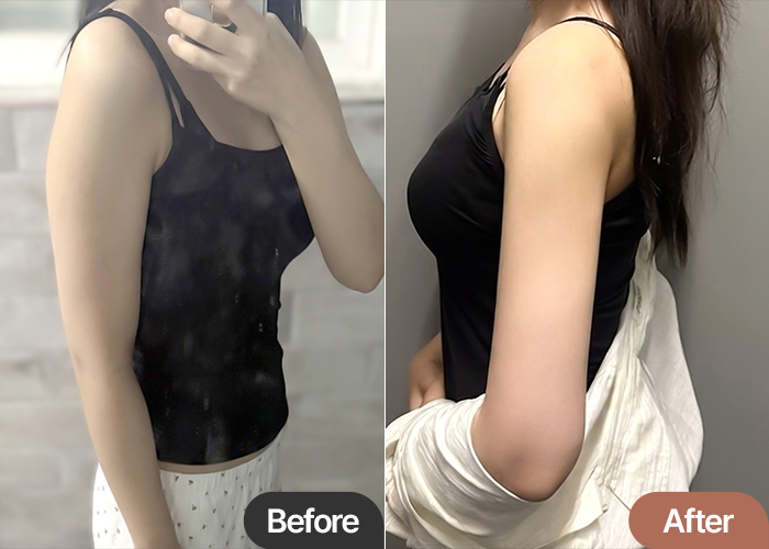 abdominal-liposuction-thumbnail-ganadinadi