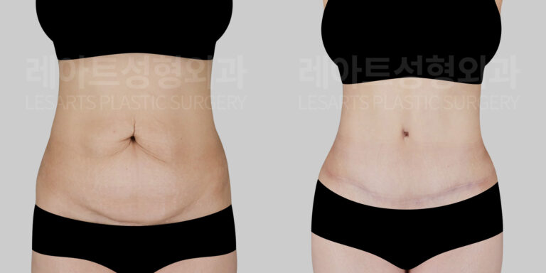 abdominoplasty-before-after-lesarts