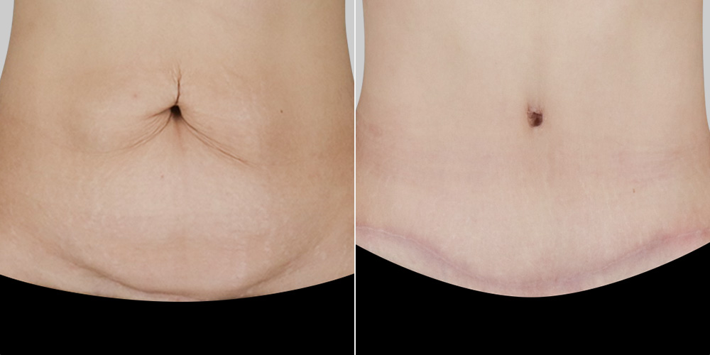 lesarts abdominoplasty-before-after-front-closeup