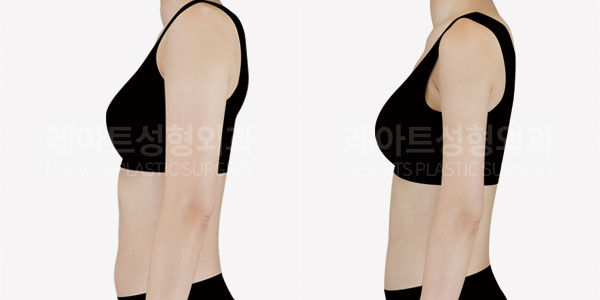 arm liposuction before after - lesarts plastic surgery