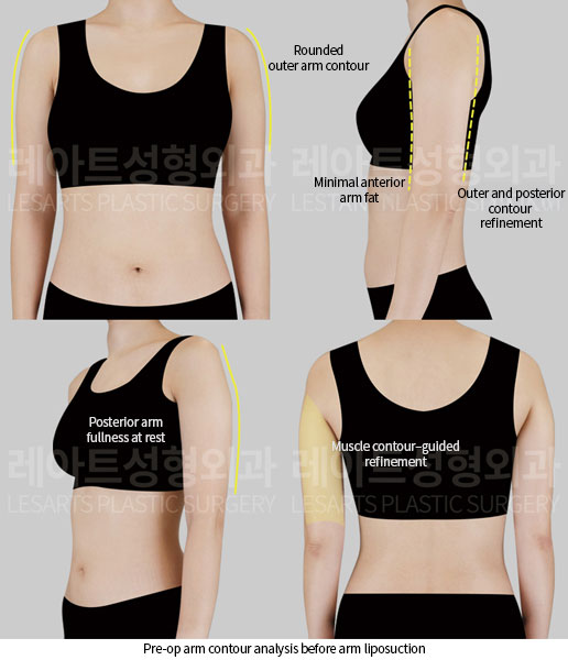 arm-liposuction-02-01-260626