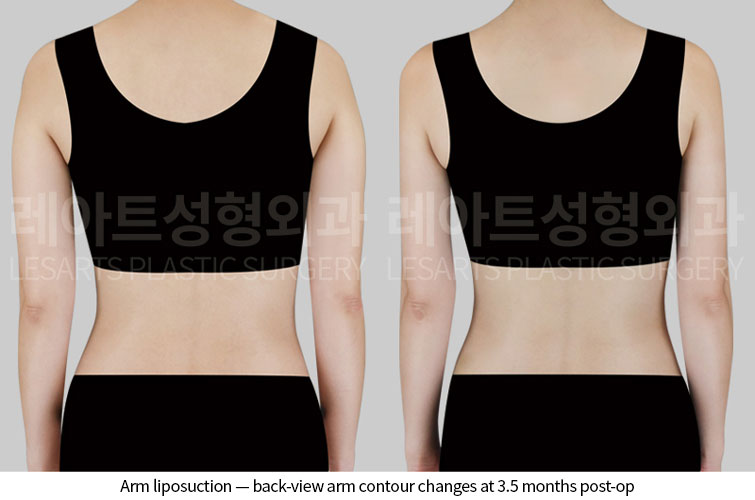 arm-liposuction-02-03-260626