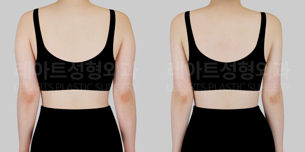arm-liposuction-before-after-back-lesarts