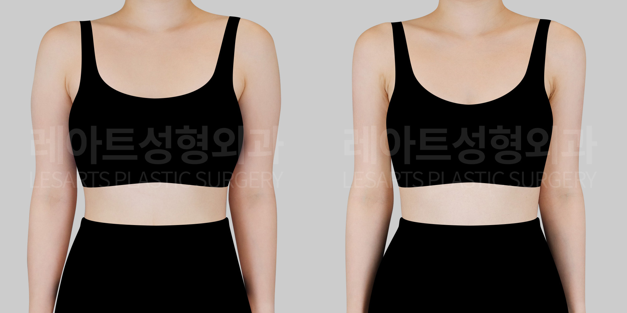 arm-liposuction-before-after-lesarts