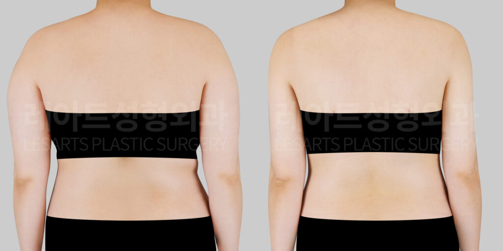arm-liposuction-before-after-back