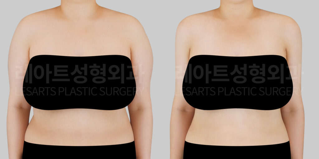 arm-liposuction-before-after-front