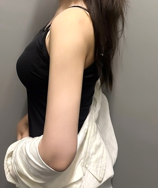 arm-liposuction-Ganadinadi-after