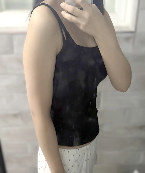 arm-liposuction-Ganadinadi-before