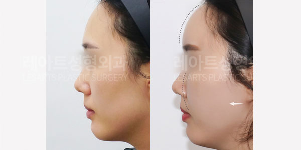 lesarts facial fat grafting before and after
