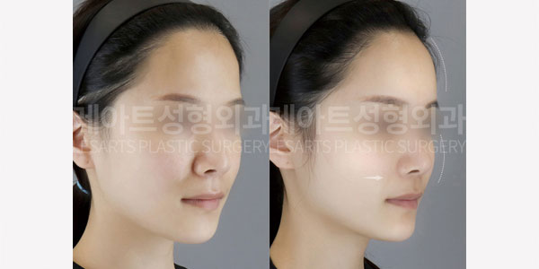 lesarts facial fat grafting before and after