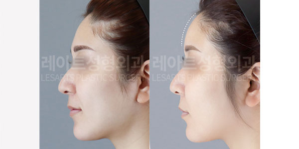 lesarts facial fat grafting before and after