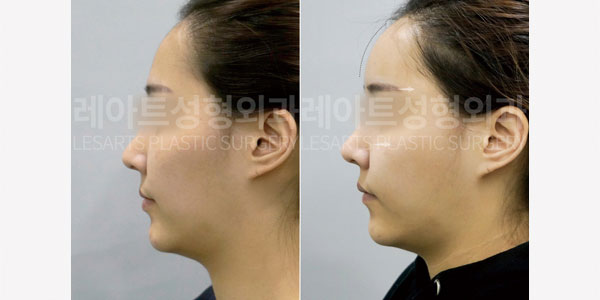 lesarts facial fat grafting before and after