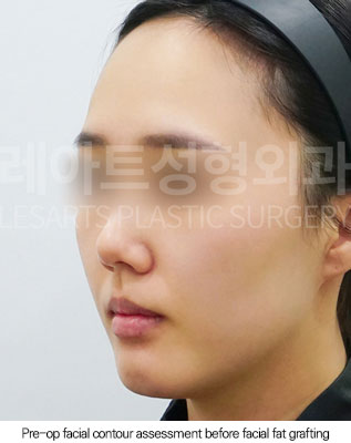 facial-fat-transfer-02-01-260102
