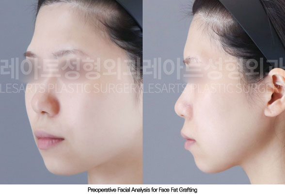 facial-fat-transfer-02-01-260108