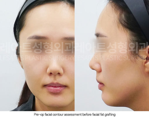 facial-fat-transfer-02-02-260102