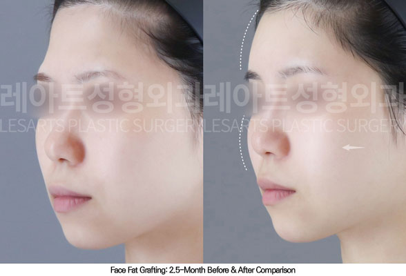 facial-fat-transfer-02-02-260108