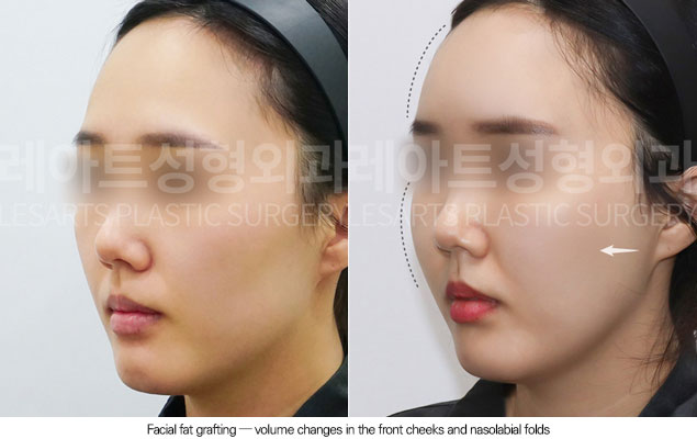 facial-fat-transfer-02-03-260102