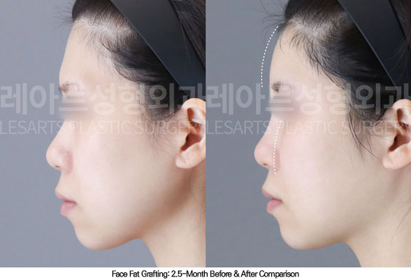 facial-fat-transfer-02-03-260108