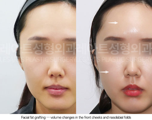 facial-fat-transfer-02-04-260102