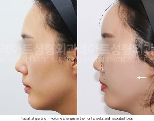facial-fat-transfer-02-05-260102