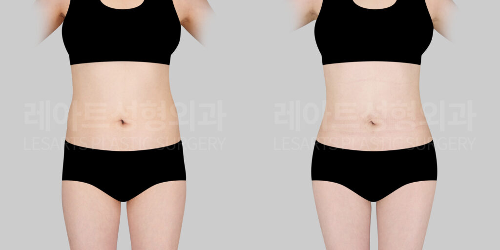 fat-grafting-before-after-lesarts