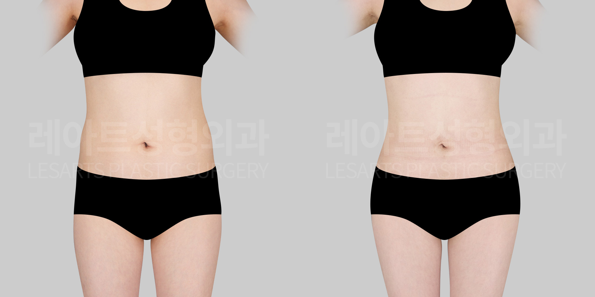 fat-grafting-before-after-lesarts