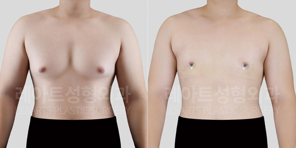 lesarts gynecomastia before and after