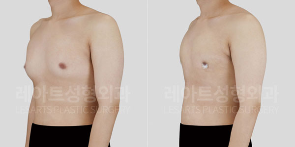 lesarts gynecomastia before and after