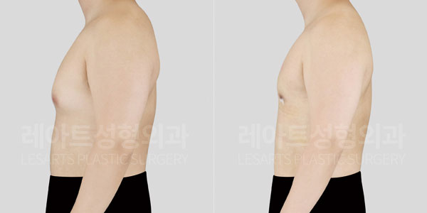 gynecomastia-01-thumbnail-260706
