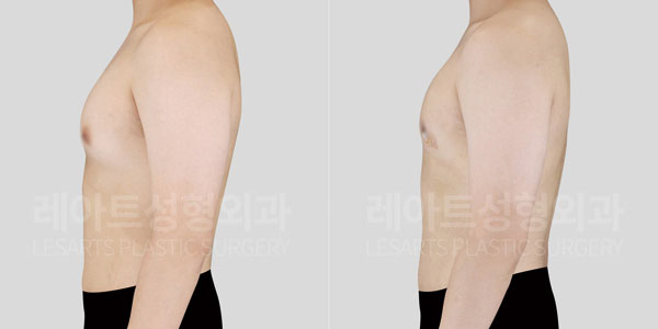lesarts gynecomastia before and after