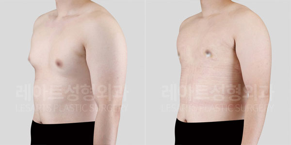 lesarts gynecomastia before and after