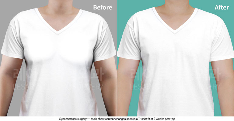 gynecomastia-02-01-260624