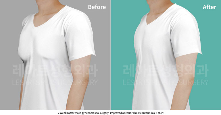 gynecomastia-02-01-260702
