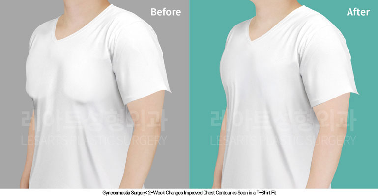 gynecomastia-02-01-260706