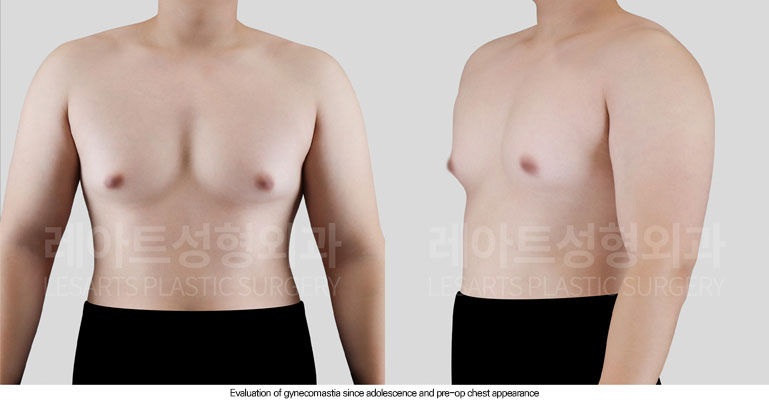 gynecomastia-02-02-260624
