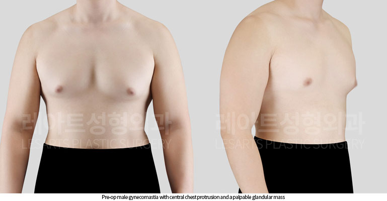 gynecomastia-02-02-260629