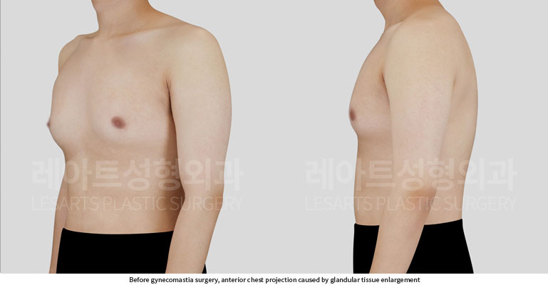 gynecomastia-02-02-260702