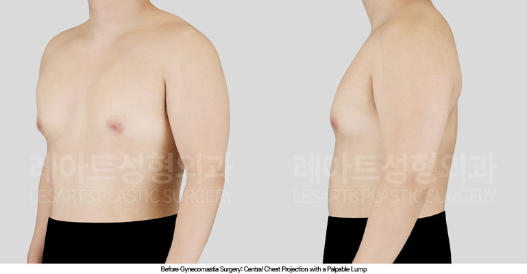 gynecomastia-02-02-260706