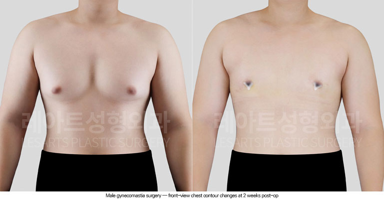 gynecomastia-02-03-260624