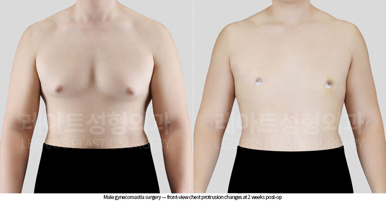 gynecomastia-02-03-260629
