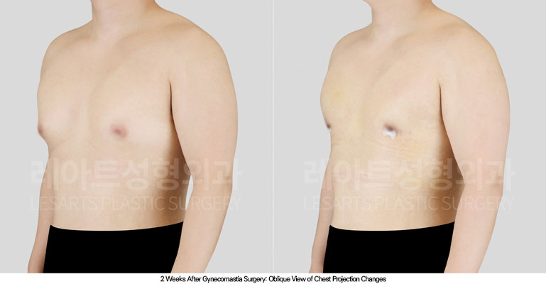 gynecomastia-02-03-260706