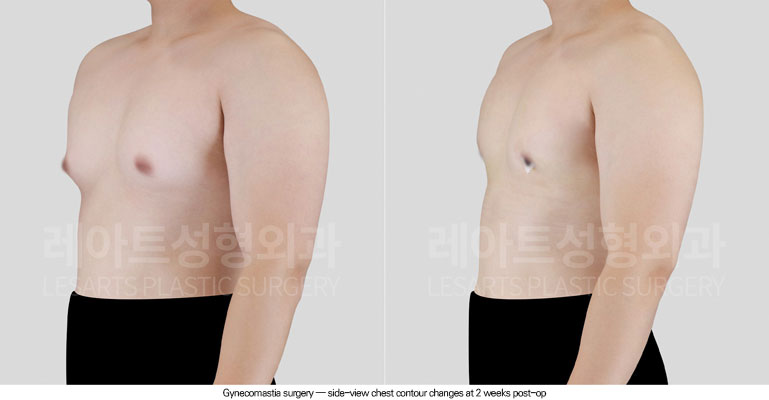 gynecomastia-02-04-260624